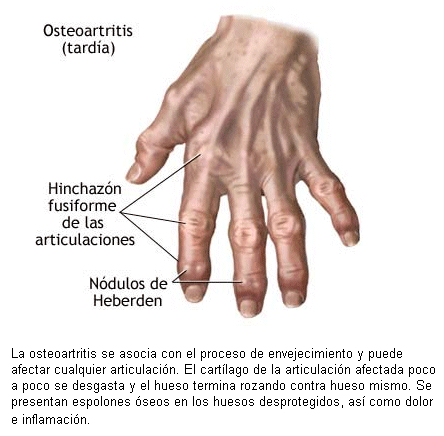 artritis